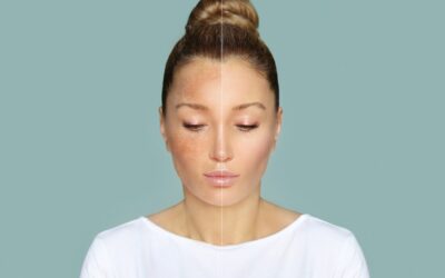 Revitalize Your Skin: How Lasers Treat Sun Damage