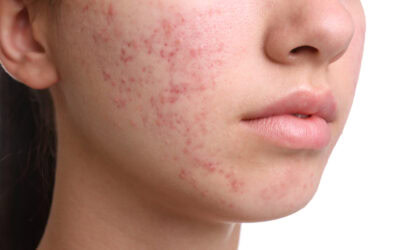 How Humidity Affects Acne and What You Can Do About It