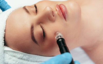 Can Microneedling Improve Acne Scars Even Years Later?